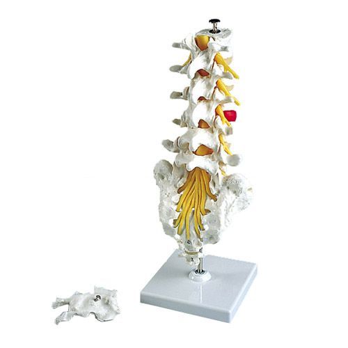 Colonne vertébrale lombaire avec prolapsus dorso-latéral a76/5