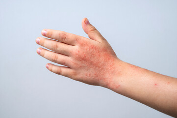 L'urticaire, une maladie chronique mal soigne ? - Girodmedical Blog : Le  blog du matriel mdical