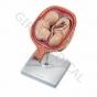 Fœtus jumeaux à 5 mois, position normale L10/7