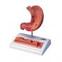 Estomac avec ulcères gastriques K17