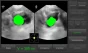 Bladder scanner / Scanner vésical Vitascan