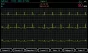 Pack promo ECG Spengler Cardiomate 3 (3 pistes) avec interprétation