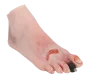 Modèle de pied blessé avec syndrome du pied diabétique Erler Zimmer