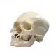 Crâne avec fissure du maxillaire et du palais A29/3