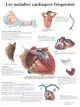 Planche anatomique Maladies cardiaque fréquentes VR2343UU