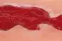 Modèle d'un ulcère veineux de la jambe en phase de granulation