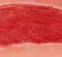 Modèle d'un ulcère artériel de la jambe en phase de granulation