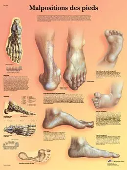 Planche anatomique Malpositions des pieds VR2185UU