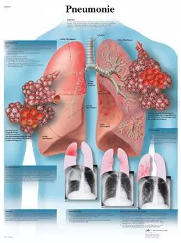 Planche anatomique Pneumonie VR2326UU