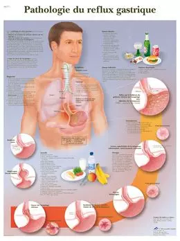 Planche anatomique Pathologie du reflux gastrique VR2711L