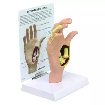 Modèle de main avec ostéoarthrite