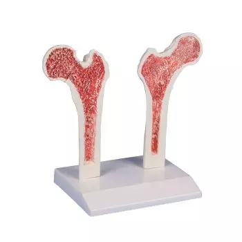 Modèle de fémur présentant une ostéoporose 4030 Erler Zimmer
