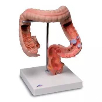 Pathologies de l'intestin K55