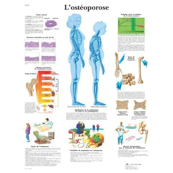 Planche anatomique L'ostéoporose B Scientific VR2121UU