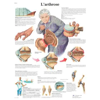Planche anatomique L'arthrose VR2123UU