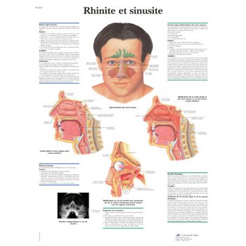 Planche anatomique Rhinite et sinusite VR2251UU