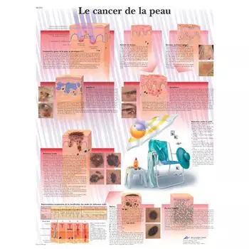 Planche anatomique Le cancer de la peau VR2295UU