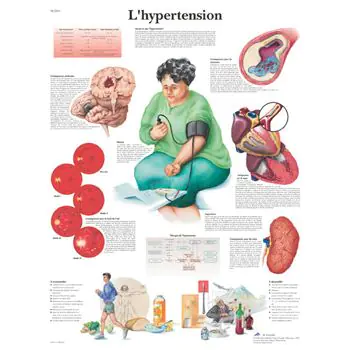 Planche anatomique L'hypertension VR2361UU