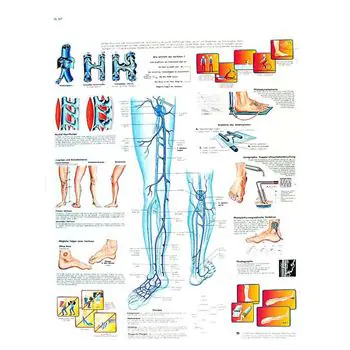 Planche anatomique Varices, varicosités VR2367UU