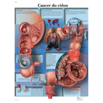 Planche anatomique Cancer du côlon VR2432L