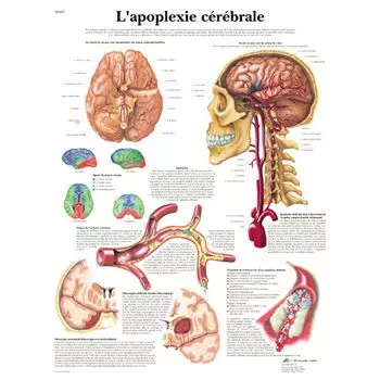 Planche anatomique L'apoplexie cérébrale VR2627UU