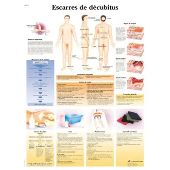 Planche anatomique Escarres de décubitus VR2717UU