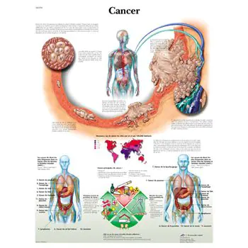 Planche anatomique Cancer VR2753UU