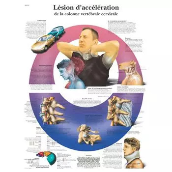 Planche anatomique Lésion d'acceleration de la colonne vertébrale cervicale VR2761UU