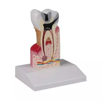 Modèle de molaire avec caries grossie 10 fois - D214 Erler Zimmer