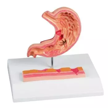 Modèle d'estomac avec ulcères gastriques Erler Zimmer