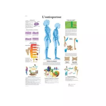 Planche anatomique l'ostéoporose VR2121L