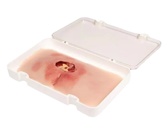 Modèle de plaie décubitus sacré nettoyé Erler Zimmer