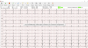 ECG numérique Spengler Cardiomate PC-ECG (12 pistes)