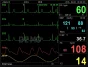 Moniteur patient multiparamétrique GIMA PC-3000 (PNI, SpO2, Temp., Resp, ECG)