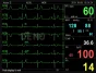 Moniteur patient multiparamétrique GIMA PC-3000 (PNI, SpO2, Temp., Resp, ECG)