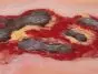 Modèle d'un ulcère artériel de la jambe en phase d'exsudation