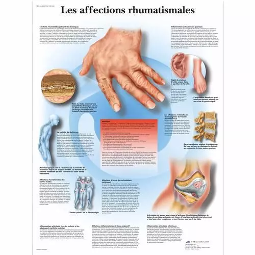 Planche anatomique Les affections rhumatismales VR2124UU