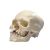 Crâne avec fissure du maxillaire et du palais A29/3