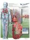 Planche anatomique Thrombose veineuse profonde VR2368UU