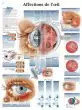 Planche anatomique Affections de l'œil VR2231L