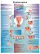 Planche anatomique Contraception VR2591UU