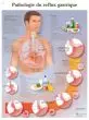 Planche anatomique Pathologie du reflux gastrique VR2711L