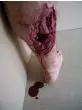 Modèle de jambe avec blessure de guerre Erler Zimmer R50010