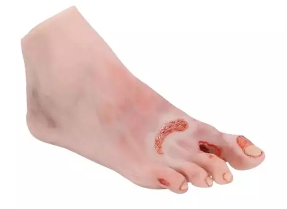 Modèle anatomique de pied diabétique au stade sévère Erler Zimmer
