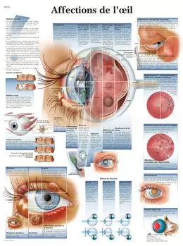 Planche anatomique Affections de l'œil VR2231L