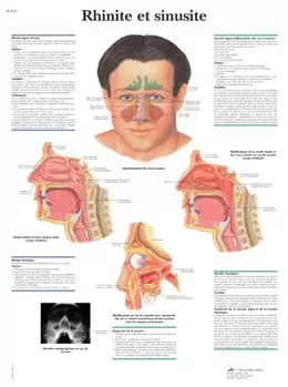 Planche anatomique Rhinite et sinusite VR2251UU