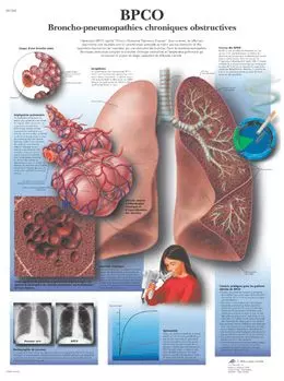 Planche anatomique BPCO Broncho-pneumopathies chroniques obstructives VR2329UU