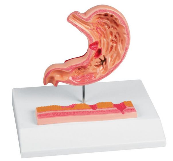 Modèle d'estomac avec ulcères gastriques Erler Zimmer