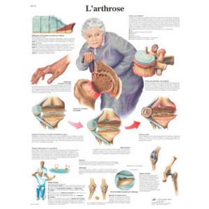 Planche anatomique L'arthrose VR2123UU