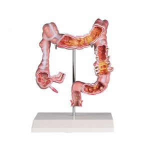 Modèle d'intestin avec maladies K285 Erler Zimmer